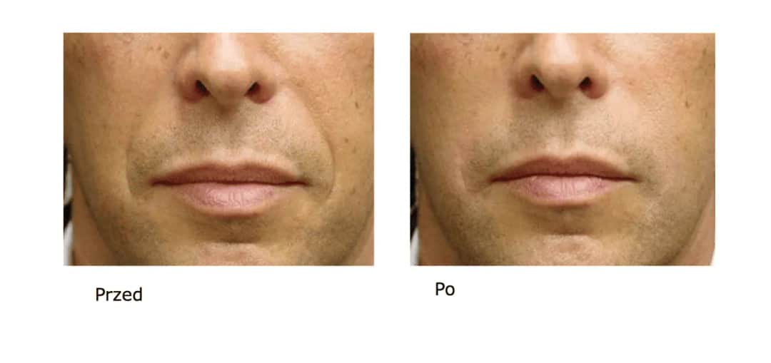 Kwas hialuronowy ile się utrzymuje – jak długo cieszyć się efektami?