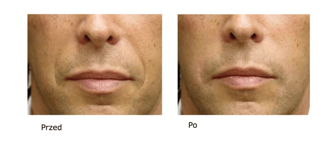 Kwas hialuronowy ile się utrzymuje – jak długo cieszyć się efektami?